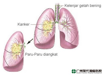 Gejala kanker paru-paru