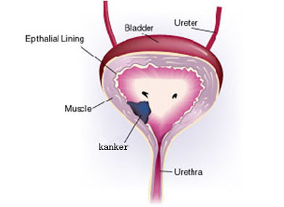 Gejala kanker kantung kemih