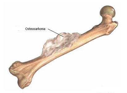  diagnosis osteosarcoma