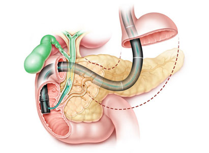 diagnosa kanker saluran empedu