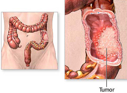 Intestinal Cancer Symptoms