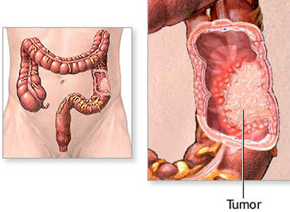 Colorectal Cancer Symptoms