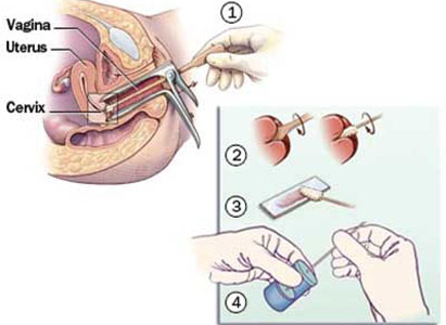 Diagnosa Kanker vagina