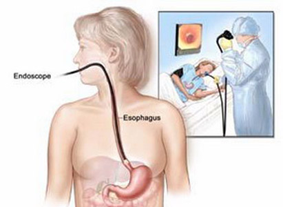 Esophageal Cancer Symptoms