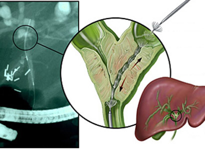 bile duct cancer diagnosis