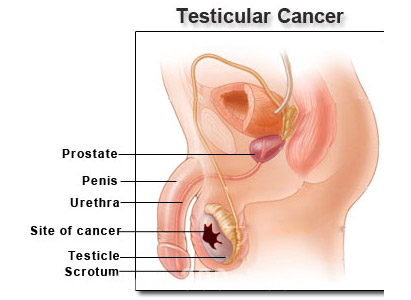 Testicular Cancer Symptoms