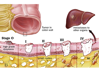 Diagnosa kanker usus 