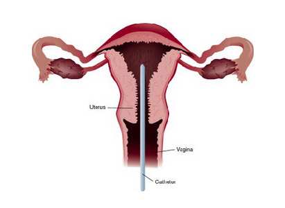 Endometrial Cancer Diagnosis