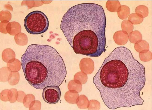 Gejala-gejala Multiple Myeloma