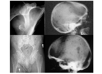 Diagnosa tumor jaringan lunak