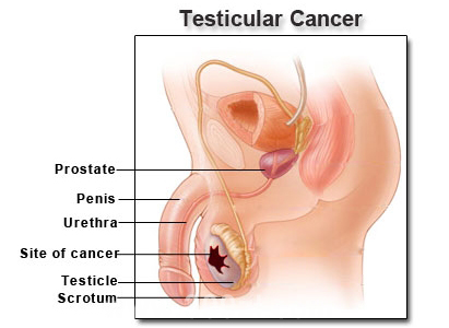 Gejala Kanker Testis