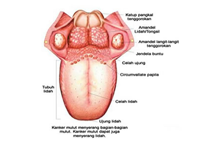 Diagnosa kanker lidah