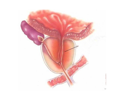 មហារីកក្រពេញប្រូស្តាត