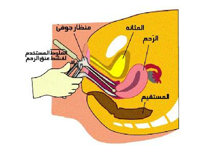  تشخيص سرطان المهبل 