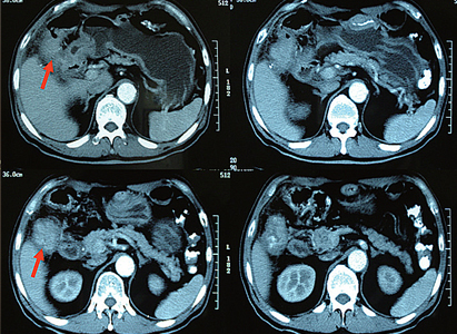 Diagnosis kanker usus duabelas jari