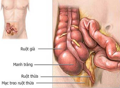 ung thư ruột