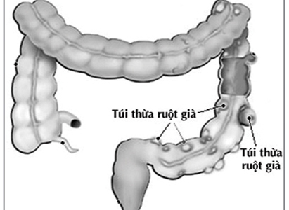 ung thư ruột kết