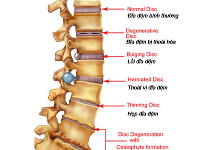 chứng thoát vị đĩa đệm