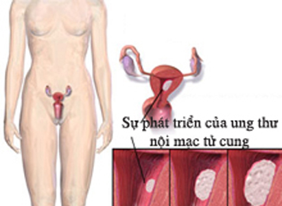  ung thư nội mạc tử cung