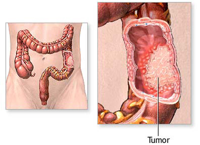 سرطان القولون