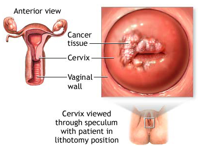 سرطان بطانة الرحم