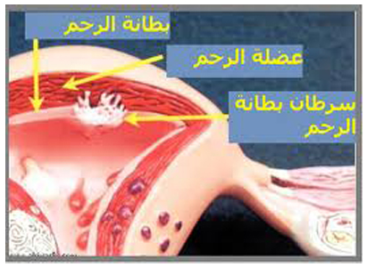 سرطان بطانة الرحم