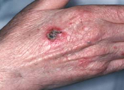  تشخيص سرطان الجلد 