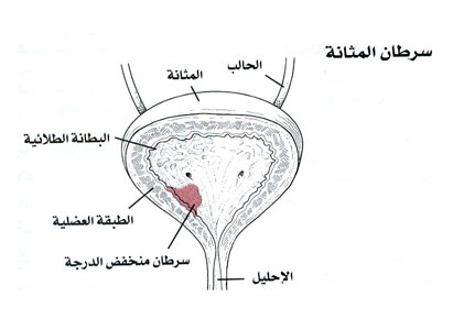  علاج سركان المثانة 