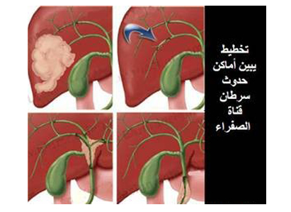  تشخيص سرطان الأوعية الصفراوية 