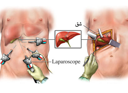  علاج سرطان الأوعية الصفراوية  