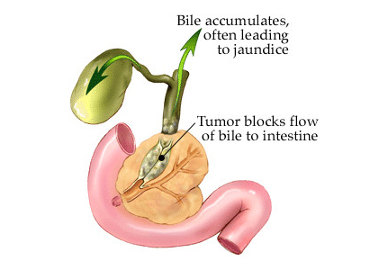  أعراض سرطان المرارة  