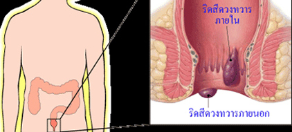 มะเร็งทวารหนัก