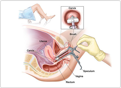 সারভিক্যাল বা গর্ভাশয় ক্যান্সার, সারভিক্যাল বা গর্ভাশয় ক্যান্সার নির্ণয়