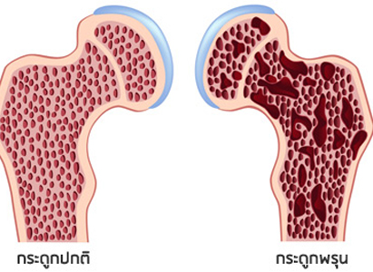อะไรคือโรคข้อสะโพกขาดเลือดเสี่อมตาย