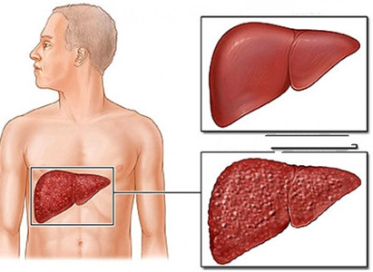 โรคตับแข็ง 1