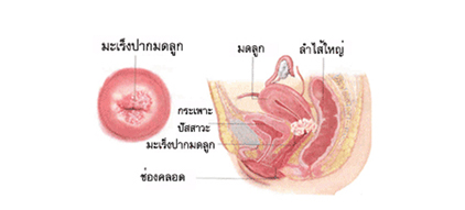 มะเร็งช่องคลอด